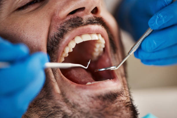Best Emergency Wisdom Tooth Extraction in Marina Del Rey, CA