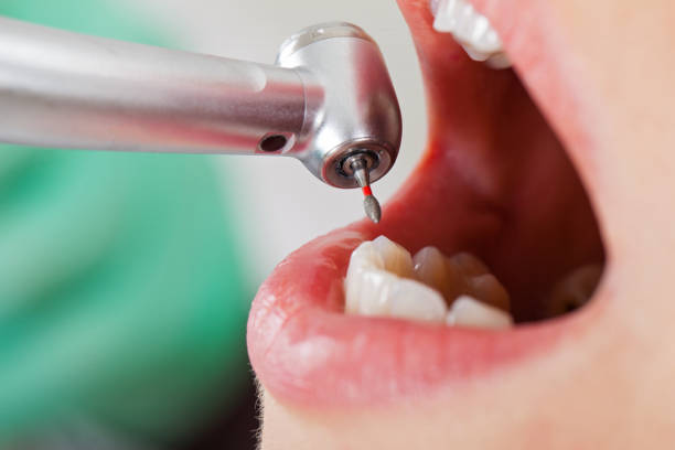 Best Lost Filling or Crown Replacement in Marina Del Rey, CA